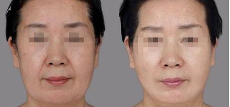 北京眼部細(xì)紋淡化醫(yī)院精排TOP10幫你選！