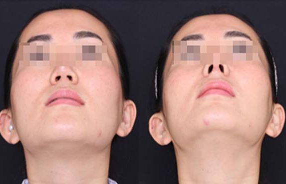 注射隆胸：完美方案！豐滿胸部美容的絕佳選擇