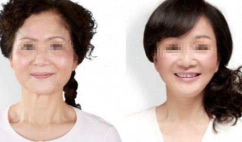 南寧整形醫(yī)院排行榜：解決面部皺紋的干細胞治療前10強