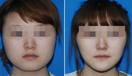 滁州眼角紋去除，整形醫(yī)院排名揭曉！