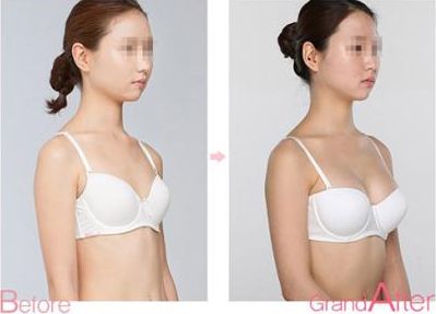 長沙痘坑激光治療口碑佳的整形醫(yī)院推薦