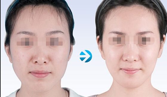 廣州眼角皺紋去除醫(yī)療美容排名分析：前10家醫(yī)院技術(shù)對比