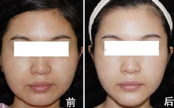 深圳腋臭手術醫(yī)院排行榜，光纖無痛除腋臭