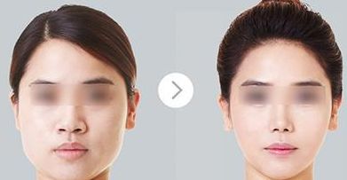 上海玻尿酸填充川字紋醫(yī)院口碑實(shí)力榜單