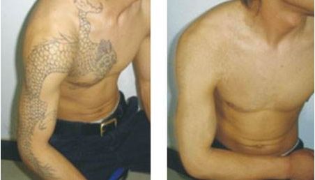 深圳哪家醫(yī)院玻尿酸填充肥胖紋效果好？排名前十強醫(yī)院揭秘