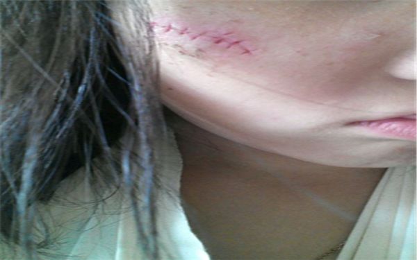 皺紋祛除解析：真假皺紋辨別技巧與激光除皺療法探秘