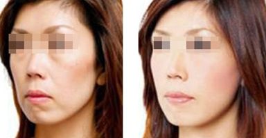 昆明最受推崇的定制美鼻術(shù)機(jī)構(gòu)專業(yè)指南