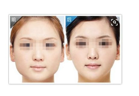 軟骨隆鼻的優(yōu)勢(shì)：效果、滿意度及相關(guān)信息一覽