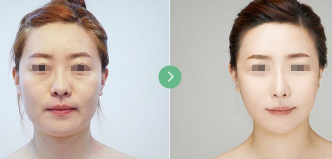 杭州眼底紋去除，這些整形醫(yī)院技術(shù)過硬！