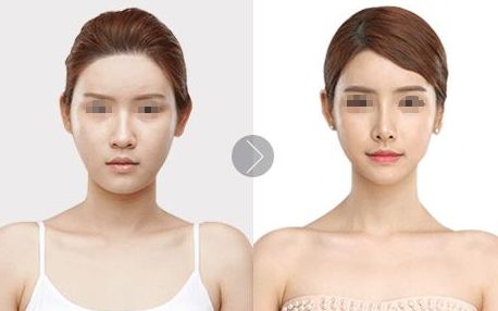 超聲溶脂：告別贅肉，輕松瘦身一步到位