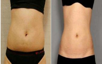 西安哪家醫(yī)院膠原蛋白填充額頭紋效果好？排行榜揭曉！