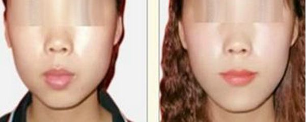 成都眼周皺紋肉毒素注射十佳整形機(jī)構(gòu)大揭秘