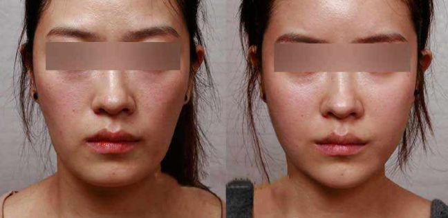 河南韓式雙眼皮修復(fù)醫(yī)院排名榜單出爐！口碑爆棚的前十大醫(yī)院揭秘