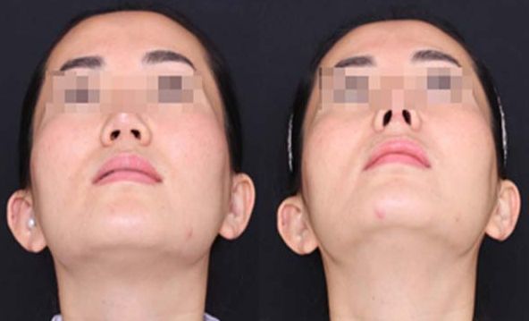 邯鄲口碑良好的痘坑整形醫(yī)院推薦，為您的美麗保駕護航