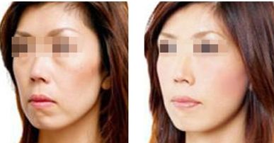 西安負壓吸脂減全身，前十家口碑美容醫(yī)院大盤點！