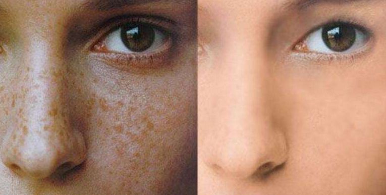 不整齊牙齒怎么辦？嘗試黃金舌側(cè)矯正，輕松迎接自信笑容！