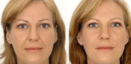 北京哪家醫(yī)院是2023年比較好的自體脂肪填充選擇？東方和諧、玉之光、禾美嘉實力對比！