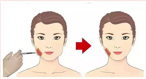 面部年輕化續(xù)寫：變美不再難，面部自體脂肪填充再次驚艷！