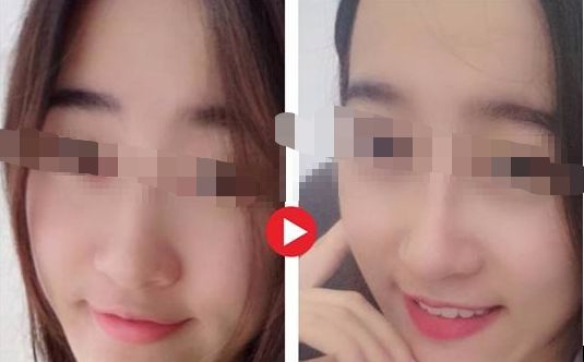 2024廣州脂肪頸脖紋填充權(quán)威醫(yī)院推薦