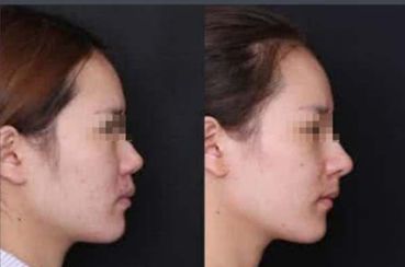 自體脂肪填充：剖析風險與禁忌事項！