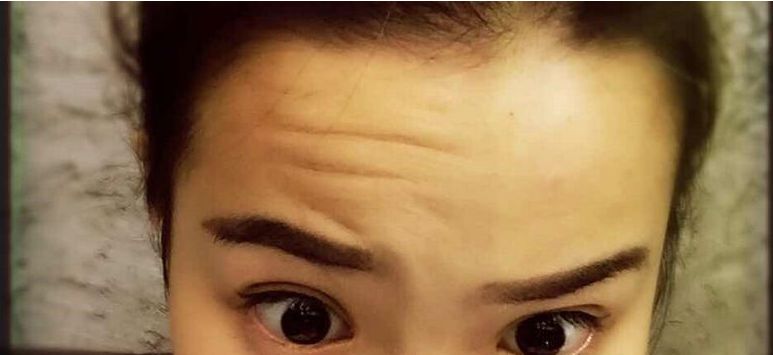 自體脂肪移植：法令紋填充的有效整形方式及注意事項