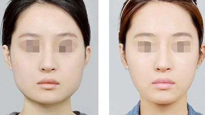 如何選擇隆鼻方法？假體還是膨體隆鼻更適合您？