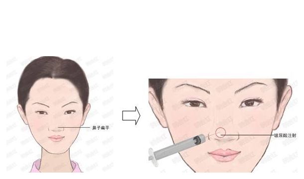 濟南王召東雙眼皮修復(fù)技術(shù)案例分享