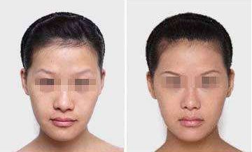 廣州哪家假體隆胸醫(yī)院評價比較好？廣州隆胸手術(shù)哪里好？廣州隆胸手術(shù)醫(yī)院榜單出爐！廣州假體隆胸哪家醫(yī)院好