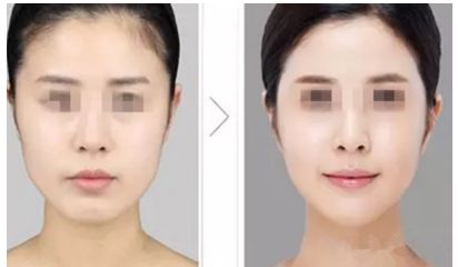 深圳整形醫(yī)院充填治療術(shù)排名前10強(qiáng)揭秘！