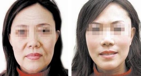 貴陽(yáng)哪家整形醫(yī)院消除抬頭紋技術(shù)最佳？