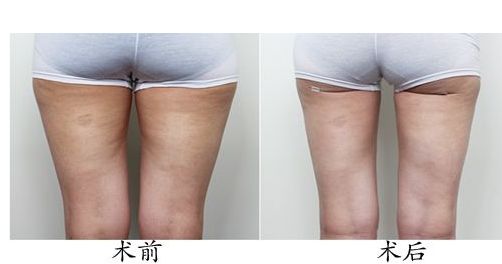 青島點(diǎn)陣激光去黑頭，這10家醫(yī)院口碑好