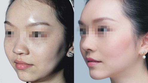 西寧隆胸醫(yī)院排名榜單揭秘！Top10暖心推薦，助您膨體自信重生！