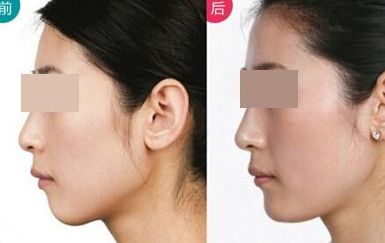 安全有效的脫發(fā)治療方法，告別禿頂困擾，重獲豐盈頭發(fā)！