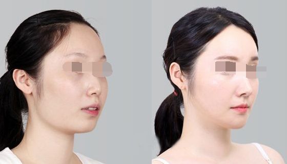 微針療法：解決脫發(fā)困擾的有效方法