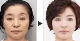 無錫黃金微針治療狐臭前十甲醫(yī)院大盤點