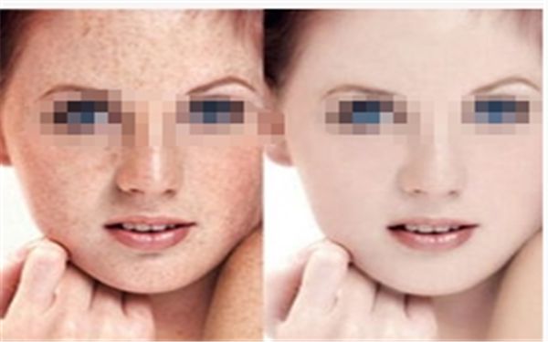 佛山哪家醫(yī)院治療眼部膠原蛋白豐淚溝效果好？排名前幾強(qiáng)？