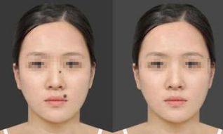 汕頭鐳射激光開眼角醫(yī)院排名TOP榜單