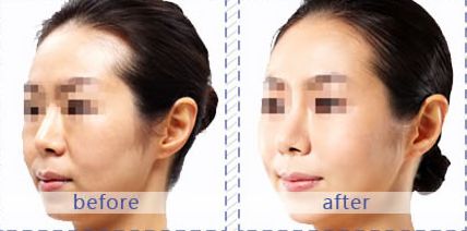 解鎖面頰凹陷：合肥十大熱門整形醫(yī)院推薦！