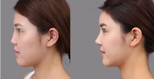 2023年蘭州填充脂肪的醫(yī)院，排行榜揭曉