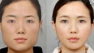 中山小腿吸脂整形醫(yī)院綜合排行榜