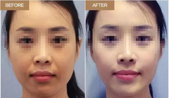 菏澤哪家整形醫(yī)院自體脂肪移植口碑最佳？排行榜公布！