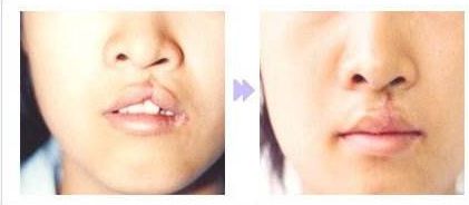 【揭秘】南通最受歡迎的翹睫雙眼皮整形醫(yī)院前十排名！