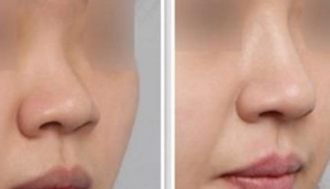 廣州最佳假體隆胸醫(yī)院排名公布，美萊、曙光享有盛譽(yù)再登榜首