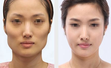 三亞V形曲線面部重塑：權(quán)威醫(yī)院口碑排行榜揭曉！