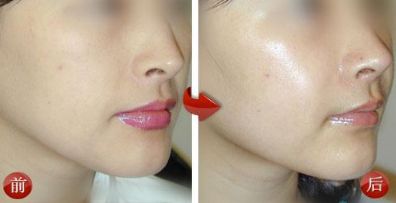 溫州口碑佳，眼部皺紋修復有良方