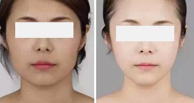 沈?yàn)槊竦男夭控S滿術(shù)表現(xiàn)如何？