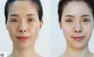 臺州祛眉間紋技術(shù)排行榜及醫(yī)院推薦！