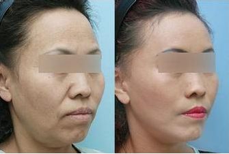 鞍山點陣激光祛疤痕醫(yī)院排名前10強！