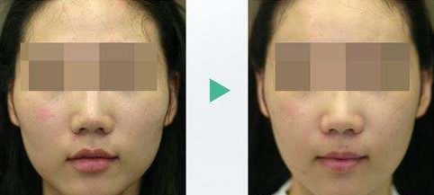 胡須移植手術(shù)的注意事項及術(shù)后護理分享