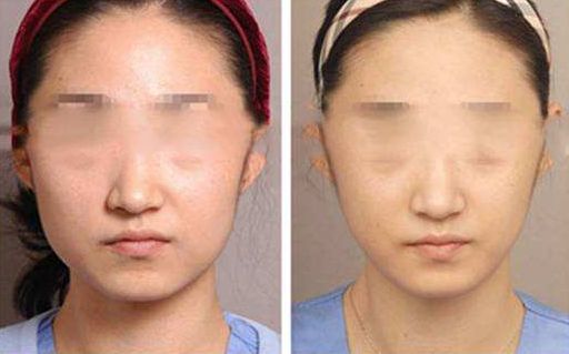 重慶哪家醫(yī)院填充玻尿酸效果好？前10強醫(yī)療美容機構(gòu)解答！